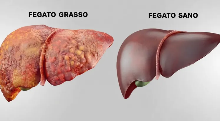 Un fegato grasso accanto a un fegato sano